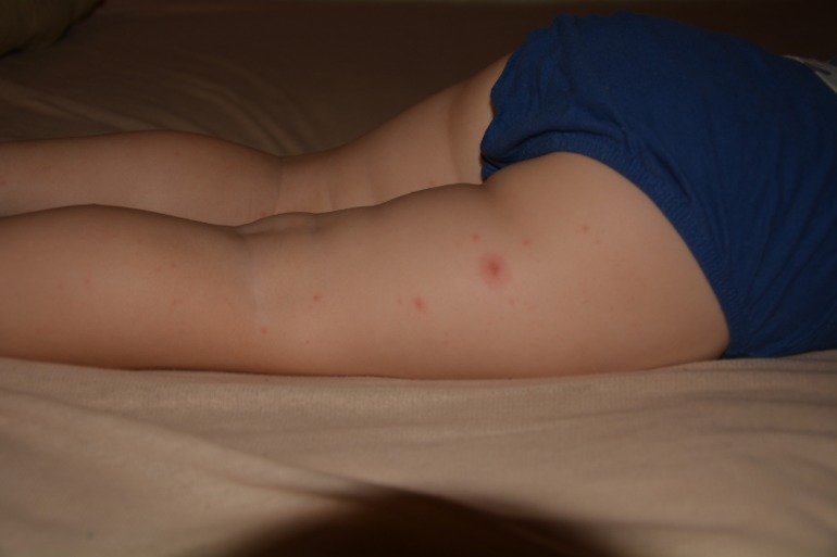 Что за прыщики?!