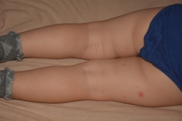 Что за прыщики?!