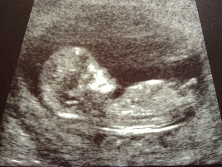 Наш 1-й скрининг