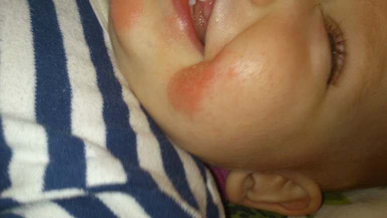 Аллергия или что-то ещё?