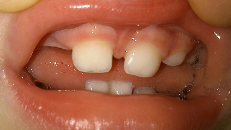 Налет на зубах