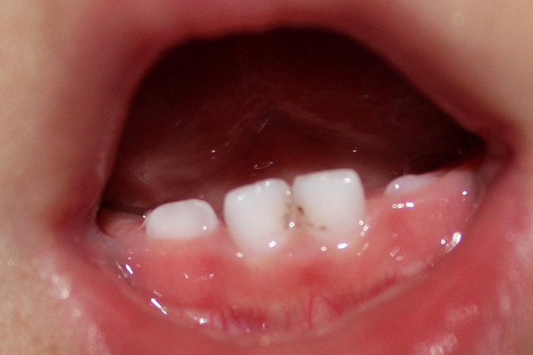 кариес? или что?