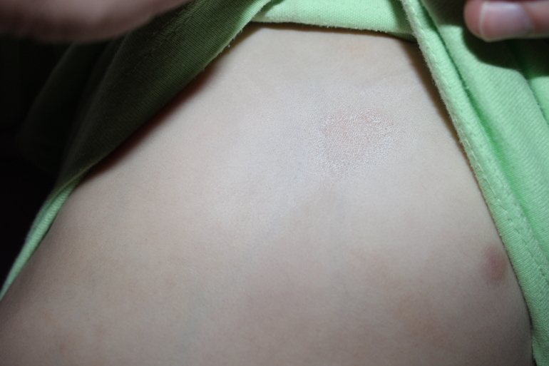 Шершавые пятна