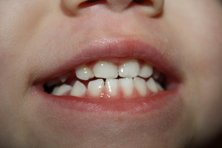 Скол на зубике. Как решить проблему?