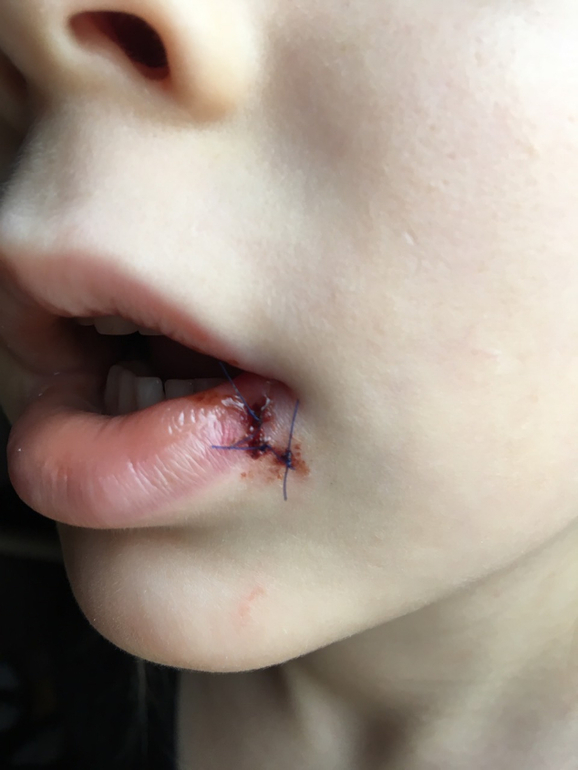 Резаные и ушибленные раны у детей