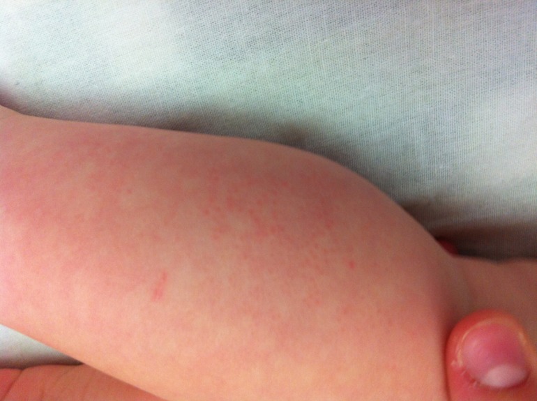 Розеола? С фото