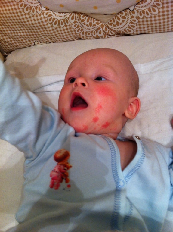 В поиске хорошего аллерголога...