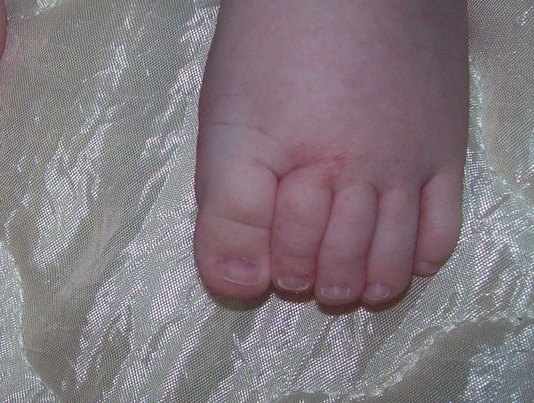 Высыпания на коже