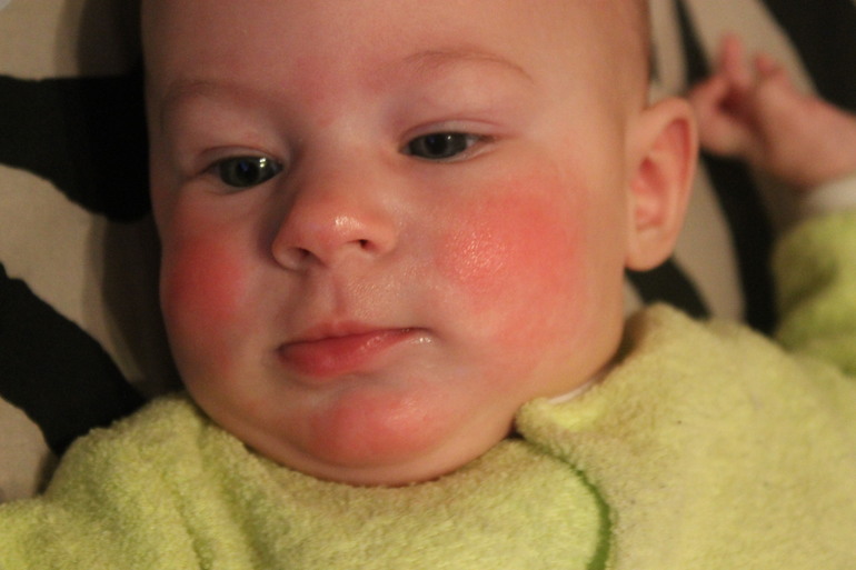 Покраснение на щеках,бороде и носу!