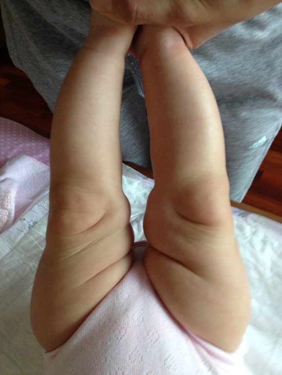 Кто о чем, а вшивый все о бане! (про витамин Д и кривые ножки)