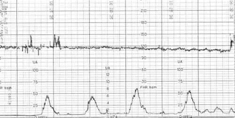 Схватки на ктг. Показатель схваток на КТГ. Сила схваток при родах на КТГ. Нормальное КТГ И при схватках. Токограмма при беременности.