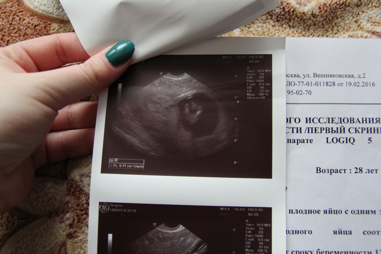 Скрининг 12 недель беременности фото