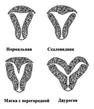 Виды матки у женщин какие бывают фото и названия