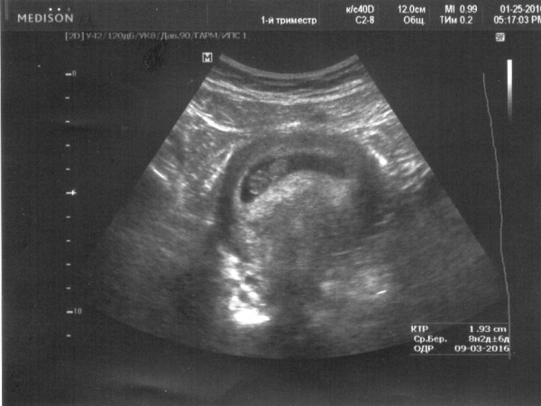 Тонус матки первый триместр. УЗИ 8 недель беременности гипертонус. Гипертонус матки на ранних сроках УЗИ. УЗИ 6 недель беременности гипертонус. УЗИ на 9 неделе беременности гипертонус.