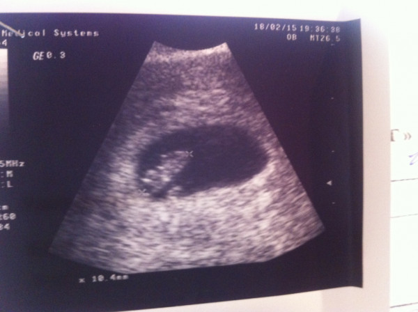 Фото на узи на 8 неделе беременности фото узи