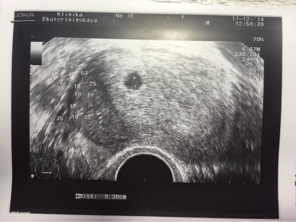 Беременность 3 недели после зачатия