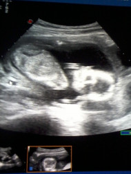Фото УЗИ на 17 неделе беременности