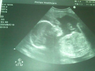 Фото УЗИ на 28 неделе беременности
