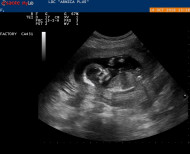 Фото УЗИ на 18 неделе беременности