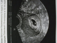 Фото УЗИ на 7 неделе беременности