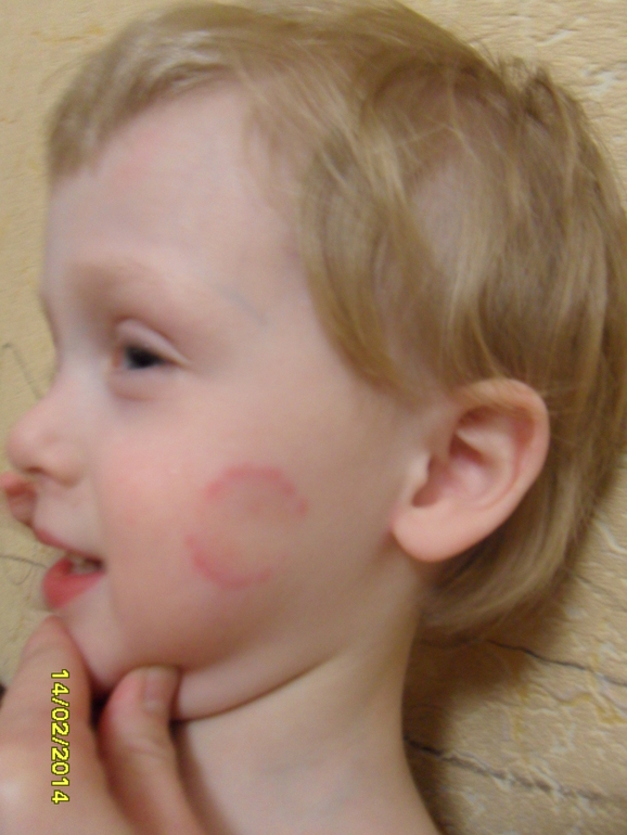 чем помазать укус от детских зубов — 12 ответов | форум Babyblog