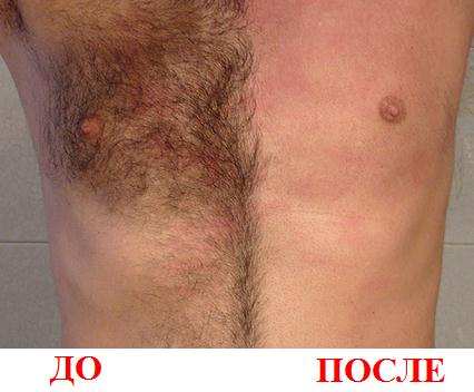 Элос эпиляция в Днепропетровске