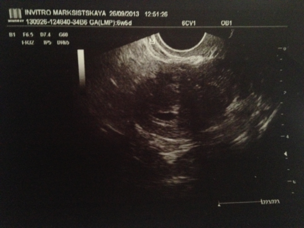 Фото узи беременности в 4 недели беременности фото