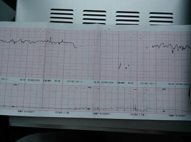 Ктг при беременности: расшифровка подготовка, как … Foto 16