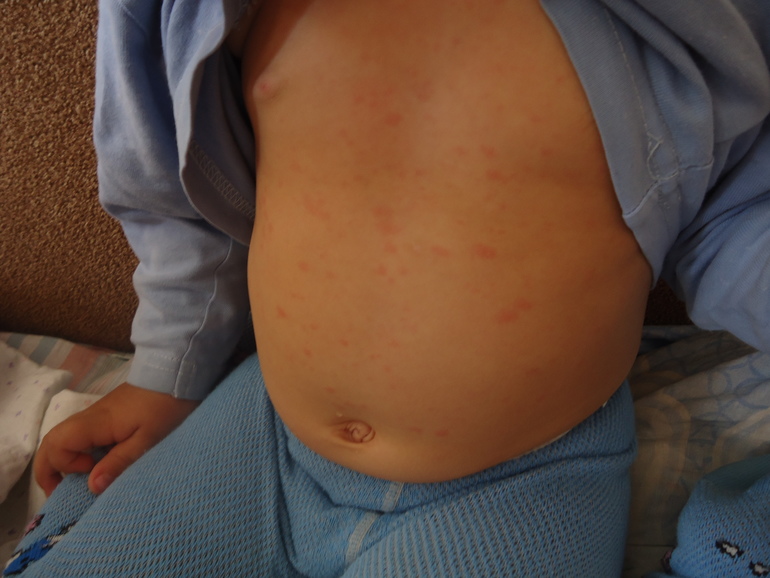 Появилась сыпь...