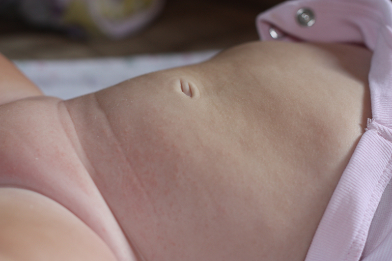 Покраснение на писе дочки Сыпь и шелушение — 44 ответов | форум Babyblog