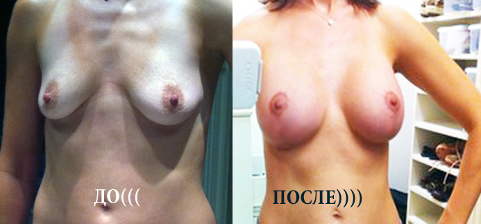 Пластика/ подтяжка груди - вся правда