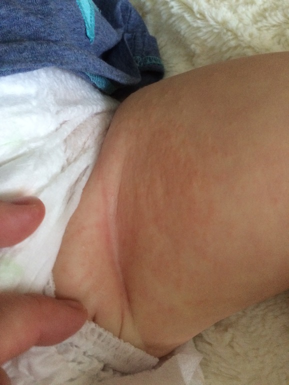 Аллергия у грудного ребёнка: кто виноват и что делать?