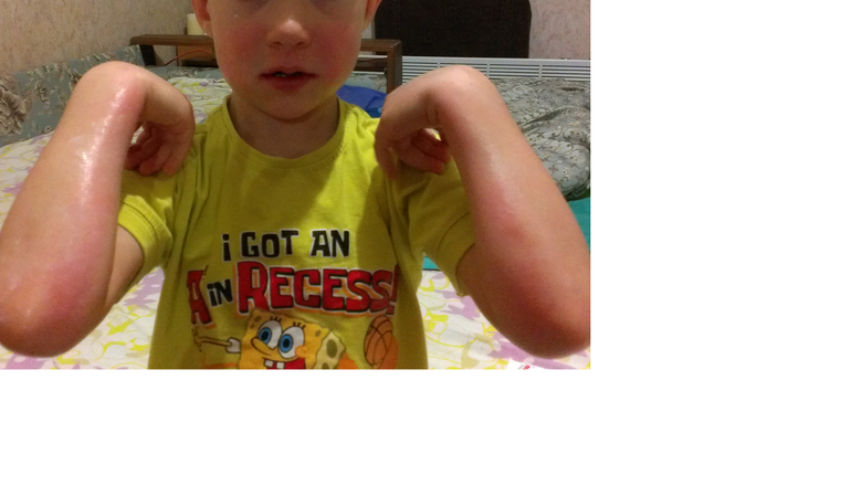 Аллергия на одуванчики у ребенка
