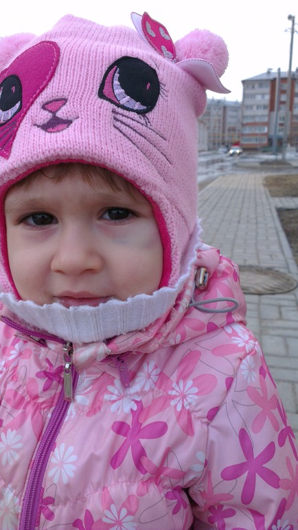 У нас Синяк, чем лечить?