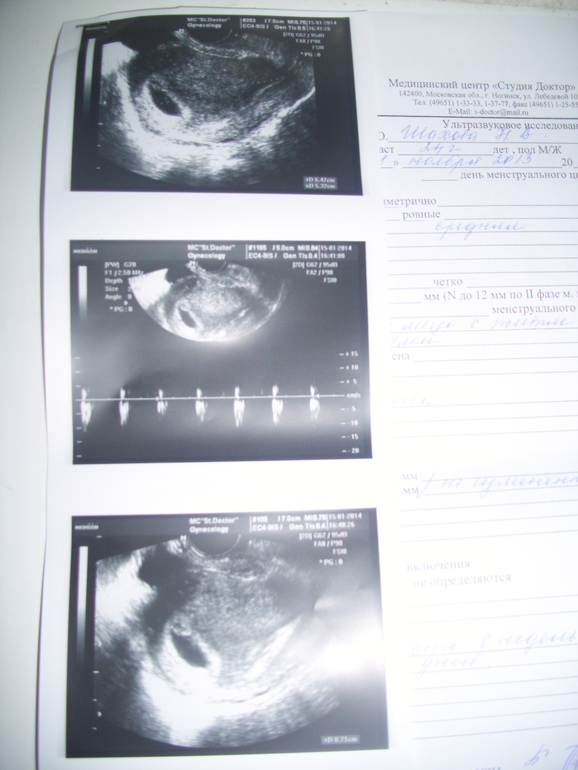 Беременность 5 недель можно. Снимок УЗИ беременности 5-6 недель. УЗИ 5-6 недель беременности. УЗИ 5-6 недель беременности фото. УЗИ 6 недель беременности.