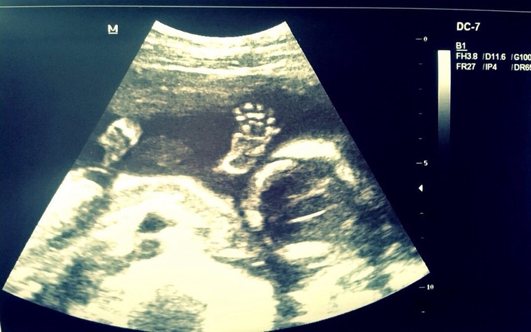 Очередное узи...