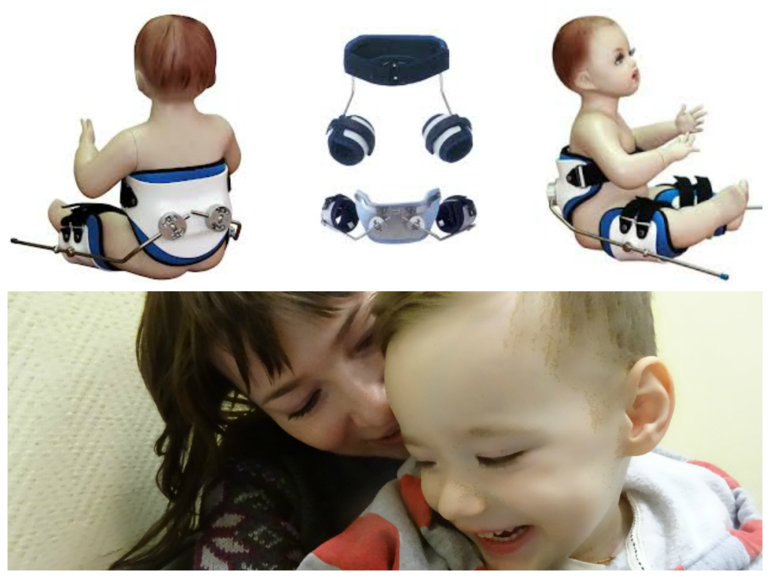 Мальчику Лёве очень необходим подвижный ортез SWASH