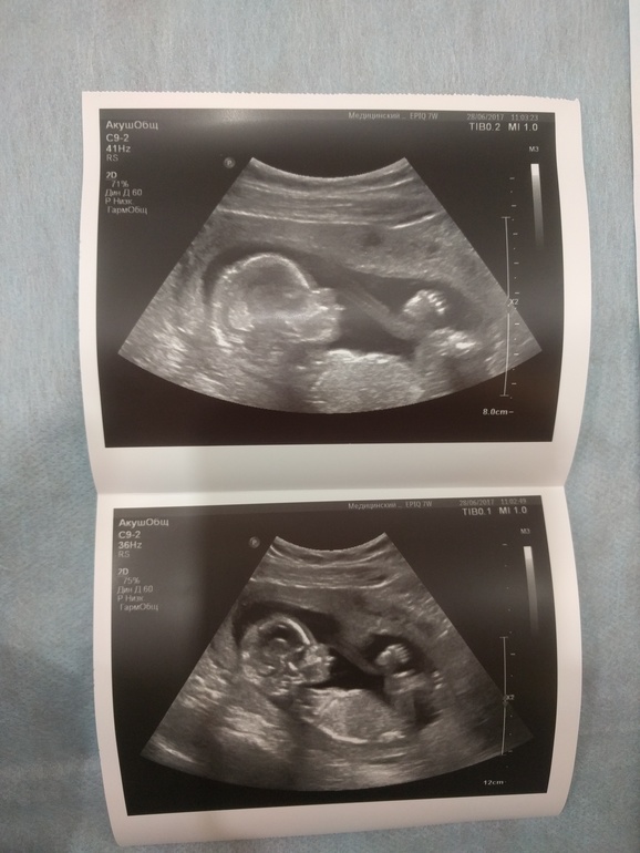 10 недель близнецы
