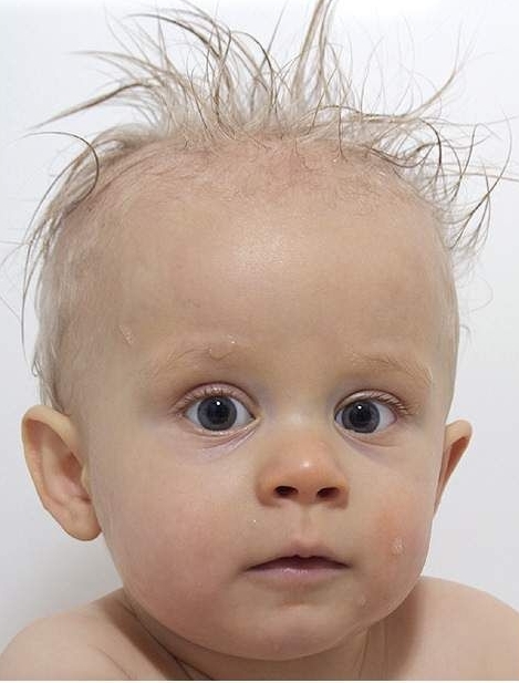 Лечение выпадения волос у детей в сети клиник НИАРМЕДИК