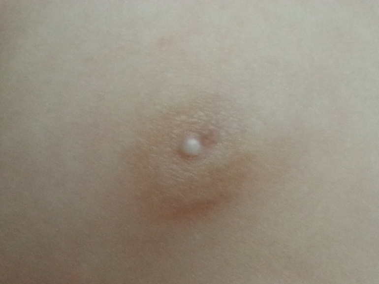 бородавка или молюск у дочи?