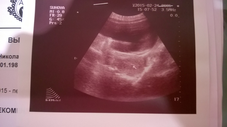 Эндометрий при переносе эмбриона