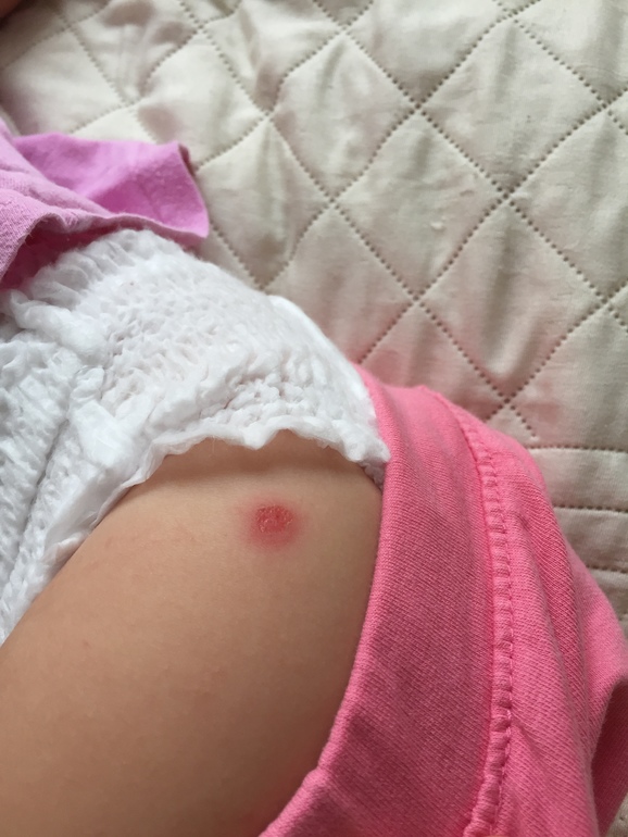 Стрептодермия у ребенка — 3 ответов | форум Babyblog
