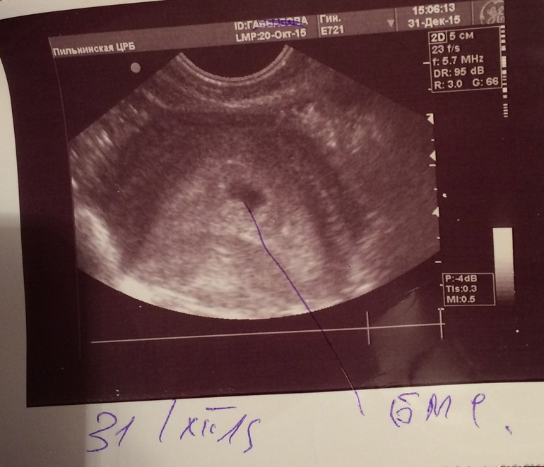 Узи срок 3 недели. Снимок УЗИ на 3 неделе беременности. УЗИ 3 недельки беременности. УЗИ беременности на 3 недели беременности. УЗИ 2-3 недели беременности.