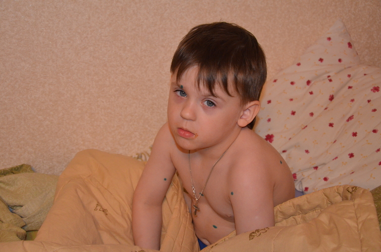 История ветрянки. Гордей.