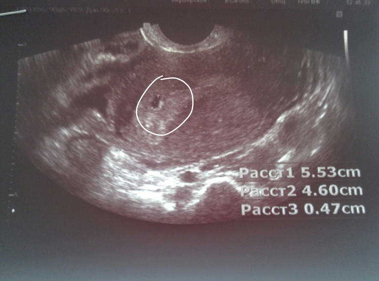 Неделя после зачатия узи. УЗИ 3 недели беременности от зачатия. УЗИ по неделям беременности. Срок 2-3 недели как выглядит. Фото УЗИ ребенка 3 недели.