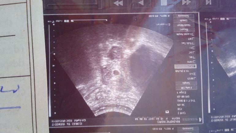 Фото узи на 5 неделе. Снимок УЗИ на 4 неделе беременности двойней. УЗИ беременности 4 недели беременности двойня. Снимок УЗИ беременности 4-5 недель двойня. Многоплодная беременность пять недель УЗИ.