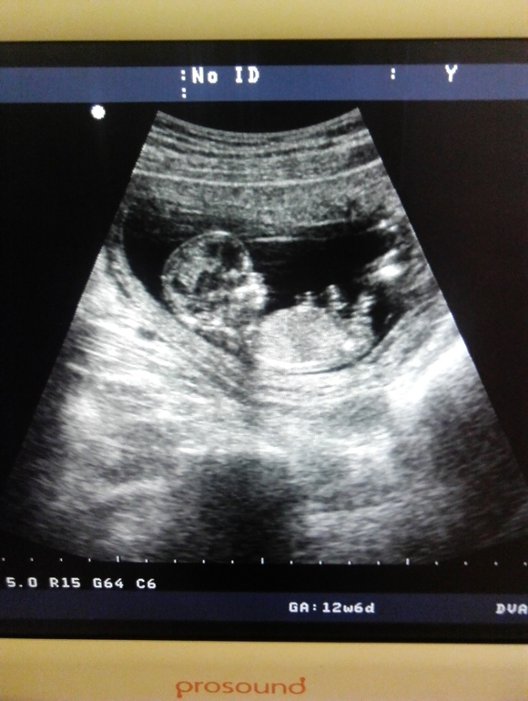 14 недель мальчик. УЗИ 13 недель беременности мальчик. УЗИ 13-14 недель беременности мальчик. Снимок УЗИ плода 13 недель.