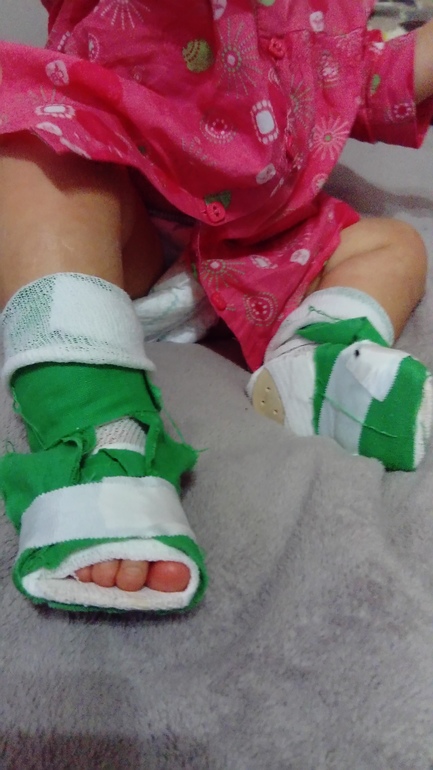 обувь от косолапия для детей — 25 рекомендаций на Babyblog.ru