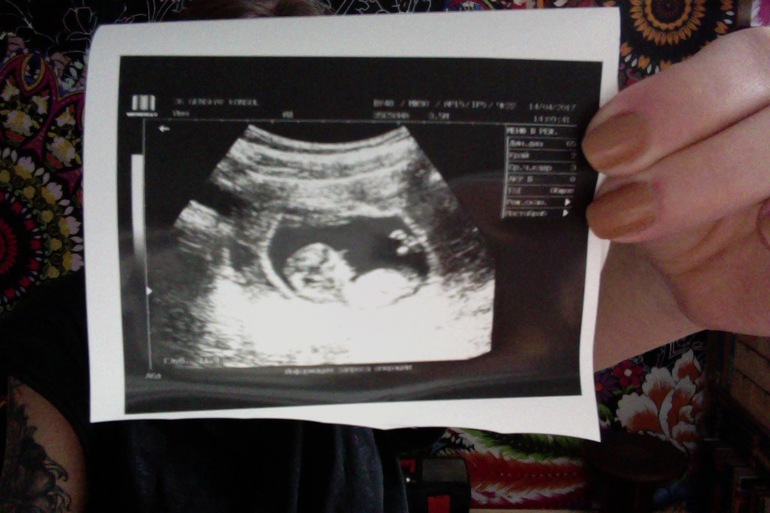 Скрининг на 14 неделе беременности. Узи 11 недель беременности. Скрининг на 14 неделе беременности. Узи 12 недель беременности. Узи по беременности 2 скрининг.