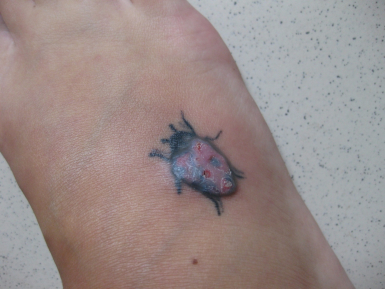 Аллергия на татуировочную краску.